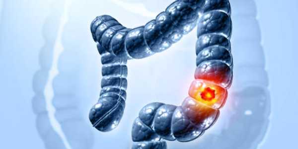 Colon Cancer Prevention: What You Need To Know By Age 50