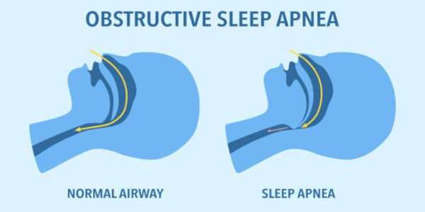 5 Surprising Symptoms Of Sleep Apnea Beyond Snoring