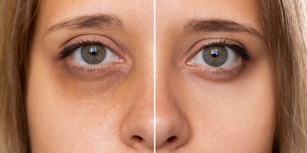 Tired Of Dark Circles And Redness? Here's How To Fix Them