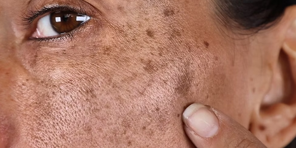 How To Get Rid Of Dark Spots & Hyperpigmentation Fast